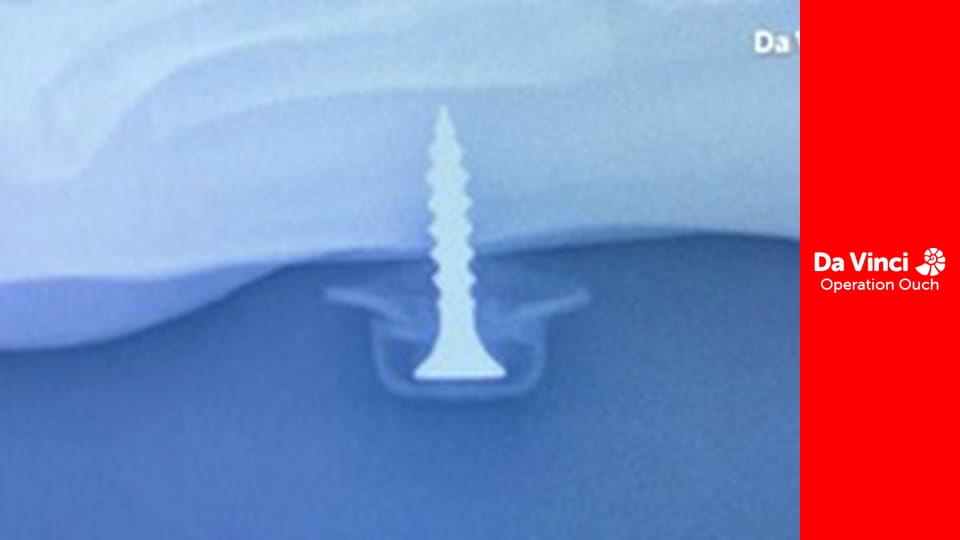 Operation Ouch! - Mouth v Knee