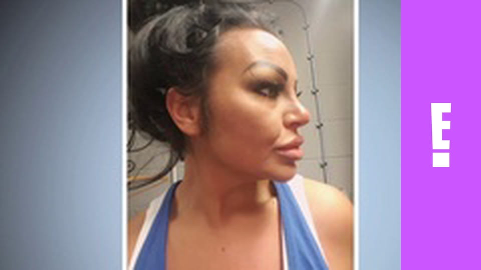 Botched S6E8 - Face Misfor-Chin