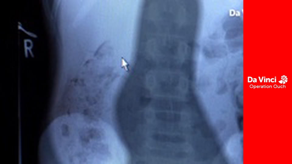 Операція «Ой!» - Від заколисування до міцного сну