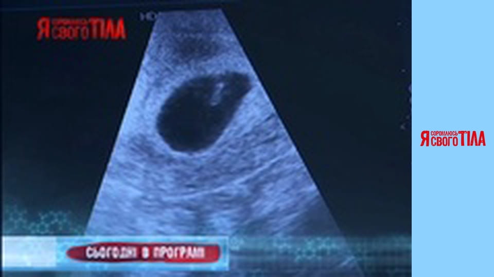 Я соромлюсь свого тіла - Сезон 5 Випуск 7 Частина 1